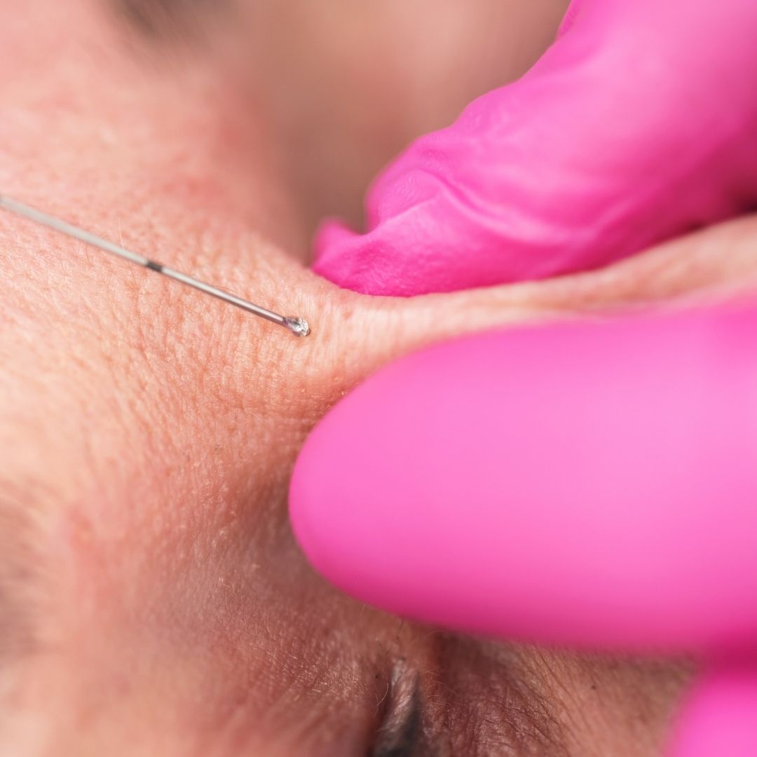 What Makes Surface Piercings Different From Dermal Piercings - Dr. Piercing Aftercare
