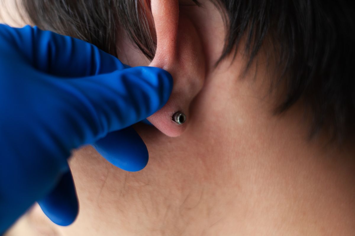 Are Piercing Keloids Normal? - Dr. Piercing Aftercare
